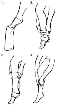 Orirose MEDICAL Чулки противоварикозные, III уровень.