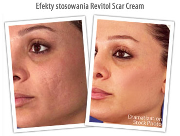 Revitol Scar Cream от шрамов, шрамов от прыщей.